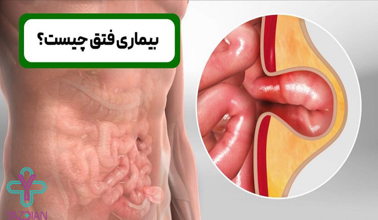 علائم فتق چیست؟